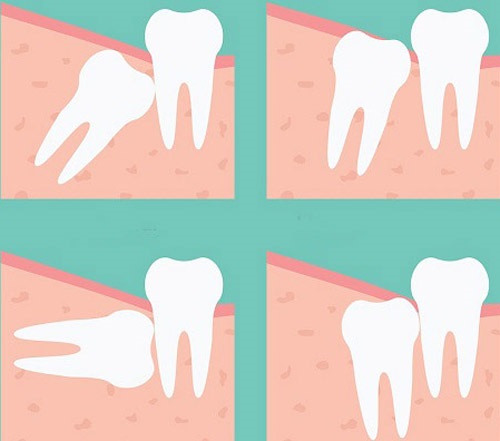 Nhổ răng khôn hàm dưới có nguy hiểm không? 3