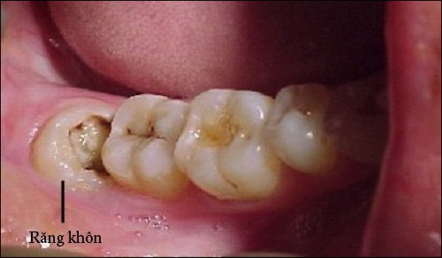 Nhổ răng số 8 có nguy hiểm không? Cần lưu ý gì? 1