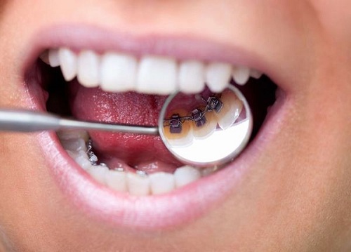 Quy trình niềng răng mắc cài mặt lưỡi như thế nào? 1