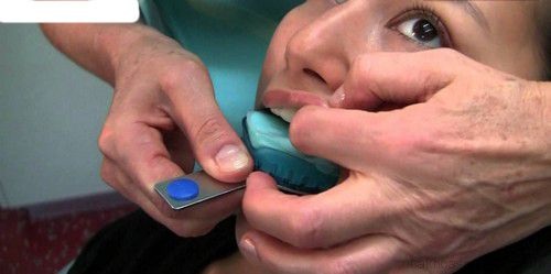 Quy trình niềng răng mắc cài mặt lưỡi như thế nào? 5