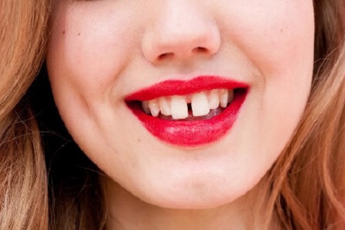 Bọc răng sứ 2 răng cửa khắc phục khuyết điểm