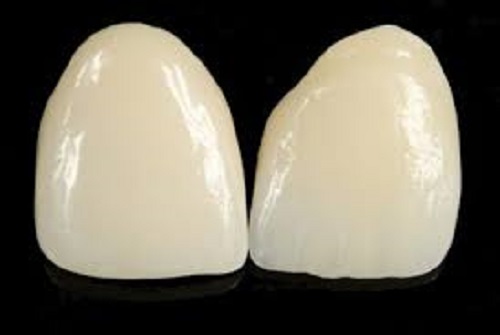 Bọc răng sứ 2 răng cửa khắc phục khuyết điểm