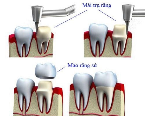 Bọc răng sứ là gì? 4 điểm cần lưu ý khi bọc răng sứ thẩm mỹ