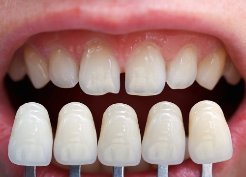 Bọc răng sứ nguyên hàm được thực hiện như thế nào?