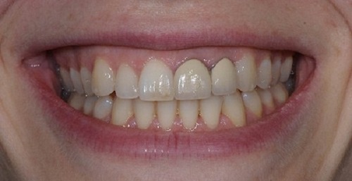 Một số lý do chính dẫn đến răng sứ bị đen viền nướu bạn nên biết-1