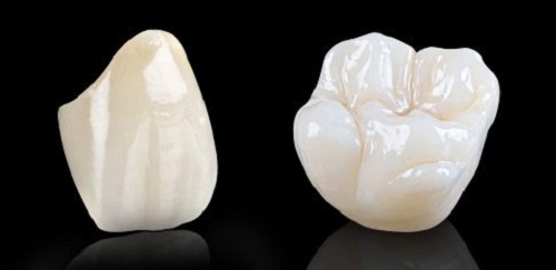 3 cách để biết răng sứ loại nào tốt nhất?-1