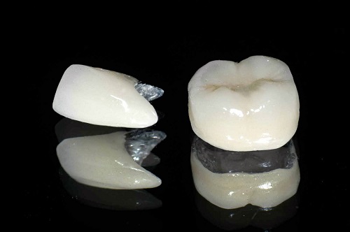 3 cách để biết răng sứ loại nào tốt nhất?-3