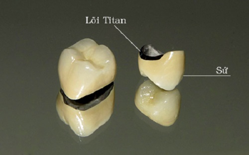 Răng sứ titan có bị đen không? Cách khắc phục-2