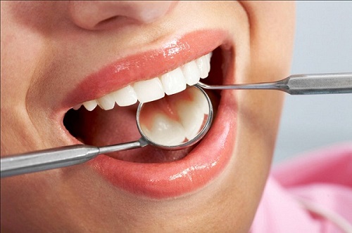 Độ bền của răng sứ titan sử dụng được bao lâu?-1