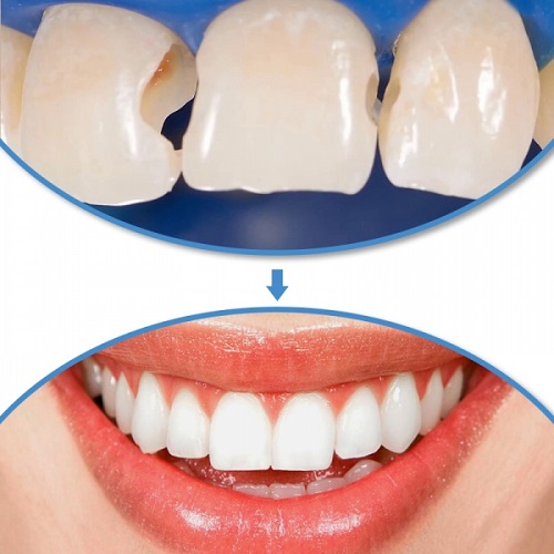 Trám răng kiêng ăn gì để đảm bảo kết quả lâu dài?1