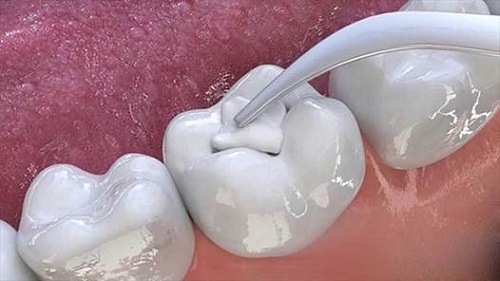 Trám răng mất bao nhiêu tiền đảm bảo chất lượng? 3