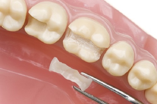 Trám răng thẩm mỹ là gì? Ưu và nhược điểm của phương pháp này 2
