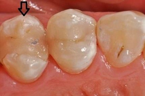 Trám răng thẩm mỹ là gì? Ưu và nhược điểm của phương pháp này 4