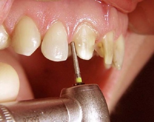 Những nguyên nhân dẫn đến bọc răng sứ bị cộm