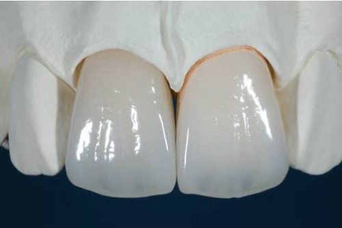 Bọc răng sứ chỉnh hô cần lưu ý điều gì?