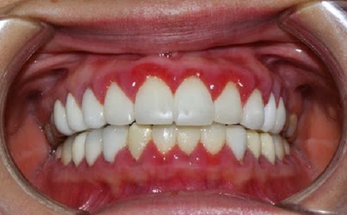Bọc răng sứ có ảnh hưởng gì không? Cần tìm hiểu kỹ
