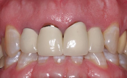 Bọc răng sứ kim loại thường có gây hại cho răng không