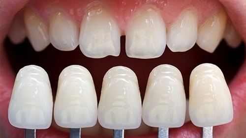 Bọc răng sứ nguyên hàm giá bao nhiêu? Giá chuẩn tại nha khoa