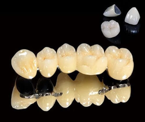 Bọc răng sứ titan có tốt không? Thông tin cần biết về răng sứ titan