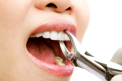 Thực hư việc nhổ răng khểnh có đau không? 2