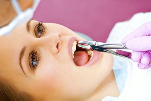 Niềng răng có phải nhổ răng không? Cần tư vấn trước khi niềng