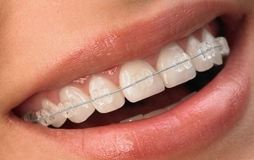 Niềng răng mắc cài pha lê thẩm mỹ từ cách điều trị đến kết quả