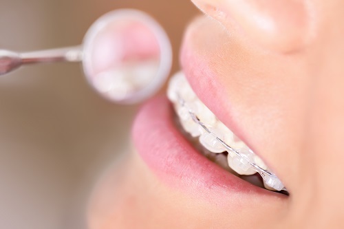 Niềng răng mắc cài pha lê thẩm mỹ từ cách điều trị đến kết quả