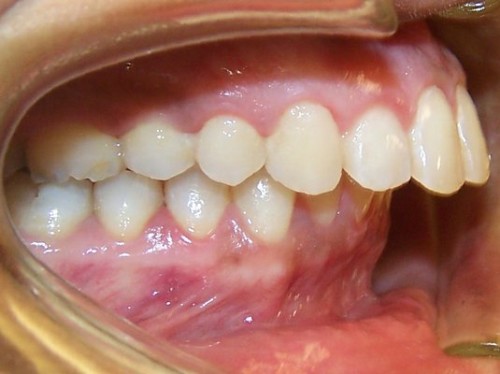 Các dạng sai khớp cắn - Và phương pháp niềng răng sai khớp cắn bạn nên biết