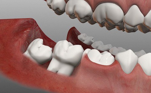 Nhổ răng khôn hàm dưới giải quyết vấn đề gì? 3