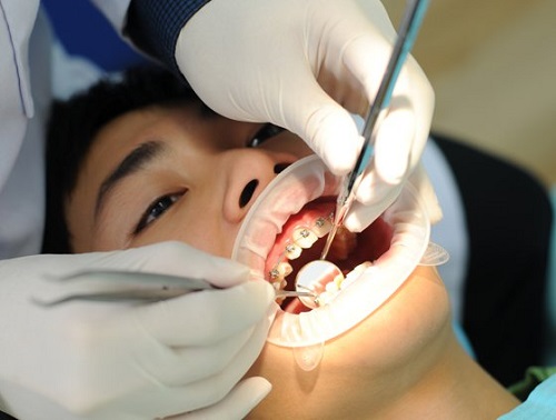 Niềng răng có nguy hiểm không? 3 thông tin cần biết trước khi niềng răng