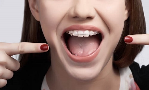 Niềng răng có nguy hiểm không? 3 thông tin cần biết trước khi niềng răng