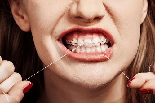 Niềng răng có tốt không? Giải quyết được vấn đề gì cho răng