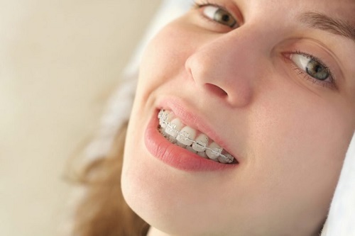 3 tiêu chí xác định niềng răng hàm trên bao nhiêu tiền cho bạn