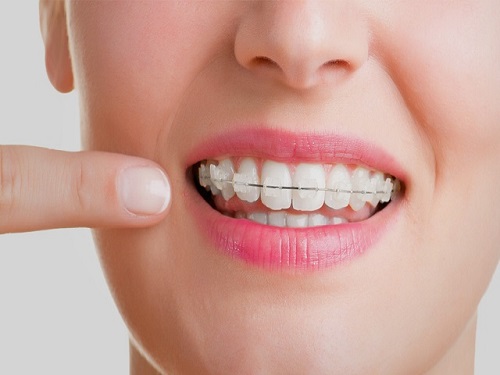 Thắc mắc niềng răng thưa 1 hàm giá bao nhiêu hiện nay-3 Thắc mắc niềng răng thưa 1 hàm giá bao nhiêu hiện nay