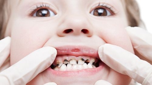 Tìm hiểu quy trình trám răng cho trẻ em 1