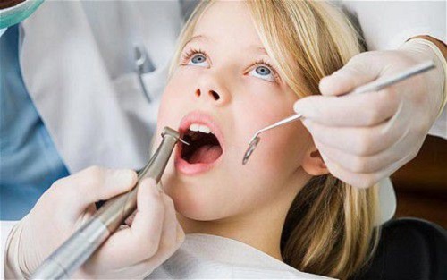 Tìm hiểu quy trình trám răng cho trẻ em 3