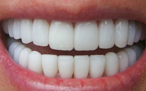Bọc răng hàm bị sâu giá bao nhiêu tiền là thực hiện được?