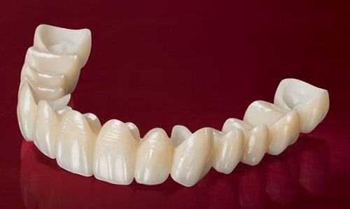 Bọc răng sứ cercon có tốt không? Lời khuyên từ khách hàng đã trải nghiệm