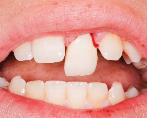 Bọc răng sứ cho răng cửa mọc lệch có được không?