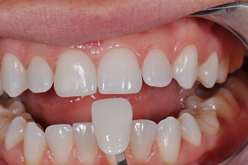 Bọc răng sứ cho răng cửa mọc lệch có được không?