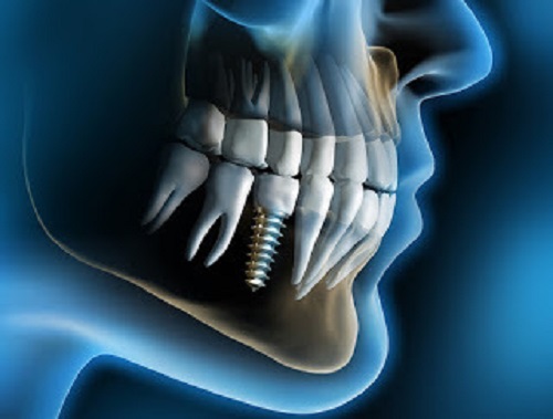 Bọc răng sứ khi bị mất răng được thực hiện như thế nào?