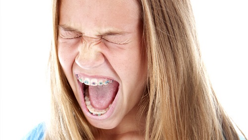 Niềng răng 1 hàm có đau không? Có ảnh hưởng gì không?