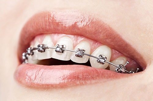 Niềng răng 1 hàm có đau không? Có ảnh hưởng gì không?