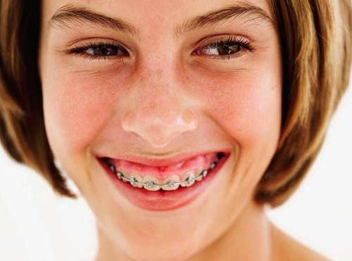 Lo lắng: Tình trạng niềng răng bị hở lợi phải làm sao?