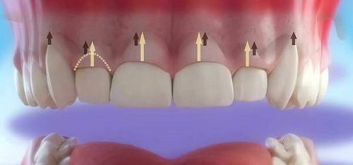 Lo lắng: Tình trạng niềng răng bị hở lợi phải làm sao?-3 Lo lắng: Tình trạng niềng răng bị hở lợi phải làm sao?
