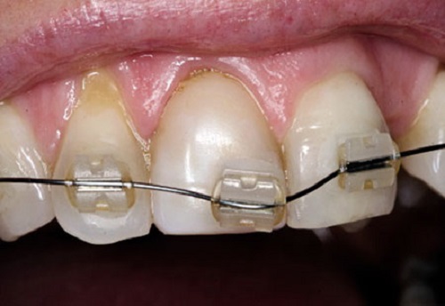 Niềng răng bị lòi chân răng có sao không? Nguyên nhân chính
