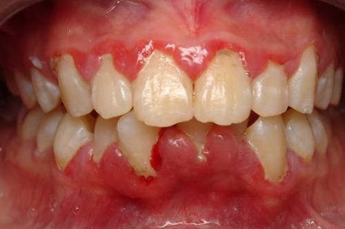 Niềng răng bị lòi chân răng có sao không? Nguyên nhân chính-2 Niềng răng bị lòi chân răng có sao không? Nguyên nhân chính