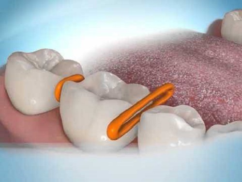 Niềng răng giai đoạn nào đau nhất bạn biết chưa?
