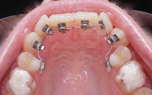 Niềng răng hàm dưới mất bao lâu? 3 yếu tố cần biết trước khi niềng răng