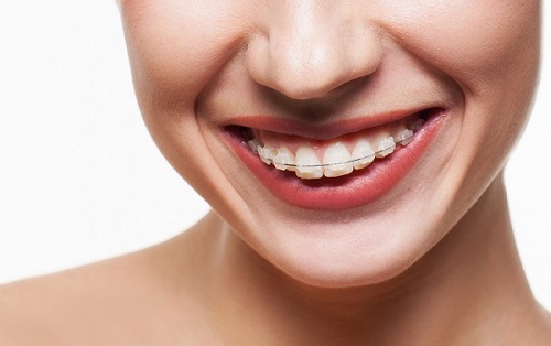Niềng răng hàm trên mất bao lâu? Quá trình có khác niềng răng nguyên hàm không